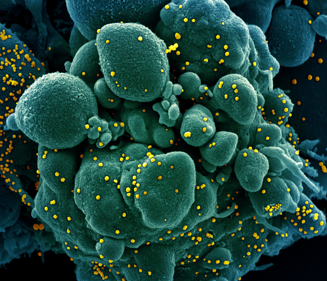 20 04 02 OP Cómo el coronavirus ataca células humanas 2 Las células están en proceso de apoptosis o autodestrucción