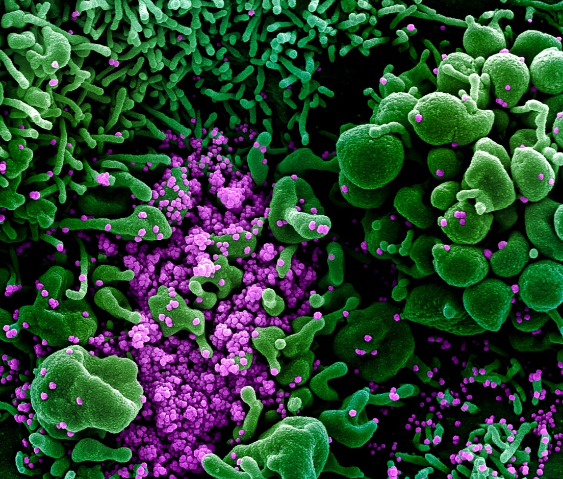 20 04 02 OP Cómo el coronavirus ataca células humanas 4 Científicos chinos divulgaron el aspecto real del virus